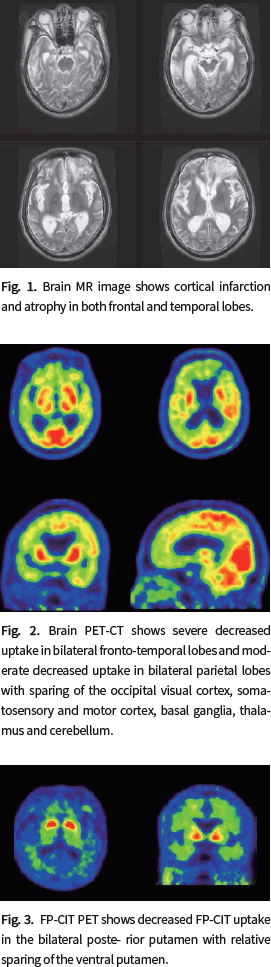 Fig. 1. Brain MR image shows cortical
infarction and atrophy in both frontal and temporal lobes.
Fig. 2. Brain PET-CT shows severe decreased uptake in bilateral fronto-temporal lobes and moderate decreased uptake in bilateral parietal lobes with sparing of the occipital visual cortex, somatosensory and motor cortex, basal ganglia, thalamus and cerebellum.
Fig. 3. FP-CIT PET shows decreased FP-CIT uptake in the bilateral poste- rior putamen with relative sparing of the ventral putamen.