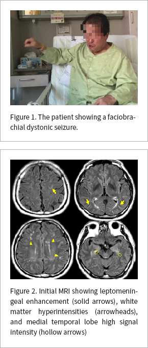 Fig. 1. Brain MR image shows cortical
infarction and atrophy in both frontal and temporal lobes.
Fig. 2. Brain PET-CT shows severe decreased uptake in bilateral fronto-temporal lobes and moderate decreased uptake in bilateral parietal lobes with sparing of the occipital visual cortex, somatosensory and motor cortex, basal ganglia, thalamus and cerebellum.
Fig. 3. FP-CIT PET shows decreased FP-CIT uptake in the bilateral poste- rior putamen with relative sparing of the ventral putamen.