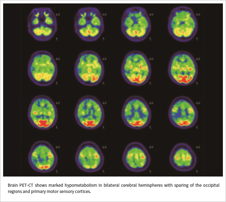 Brain PET-CT shows marked hypometabolism in bilateral cerebral hemispheres with sparing of the occipital regions and primary motor sensory cortices.