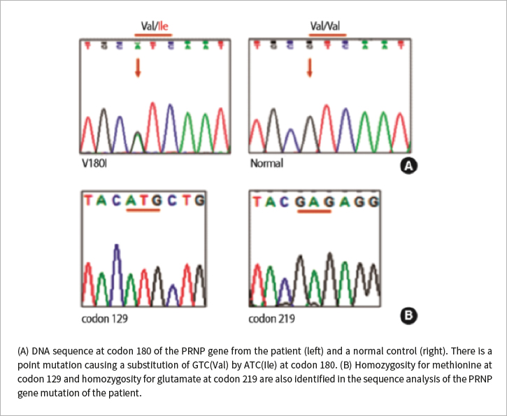 (A) DNA sequence at codon 180 of the PRNP gene from the patient (left) and a normal control (right). There is a point mutation causing a substitution of GTC(Val) by ATC(Ile) at codon 180. (B) Homozygosity for methionine at codon 129 and homozygosity for glutamate at codon 219 are also identified in the sequence analysis of the PRNP gene mutation of the patient.